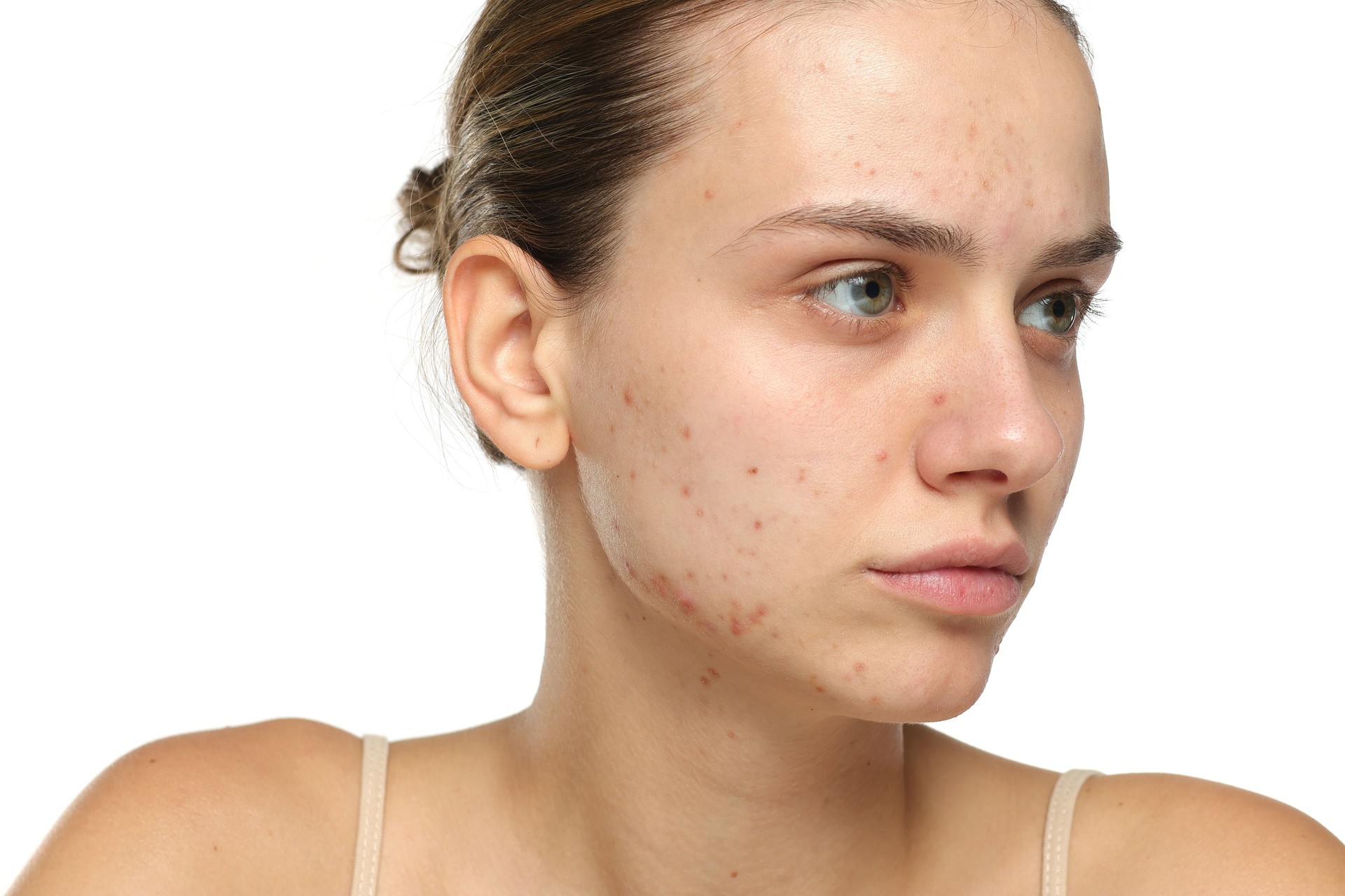 Studio shot of young woman with acne looking away, skincare concept, white background.